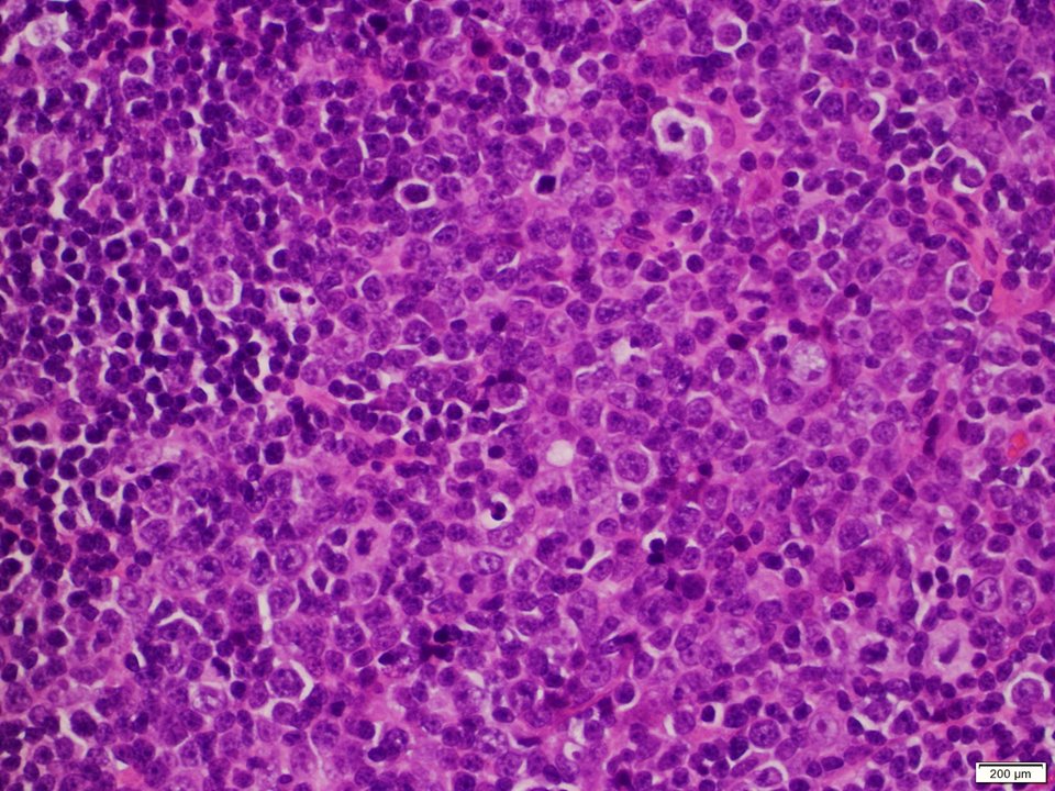 (3/3) High power view of the large cell transformation component (with numerous centroblasts and immunoblasts), and adjacent FL component  #hemepath  #LJMFridayUnknowns  #VirtualHemepathMDA  #lymsm  #endcancer