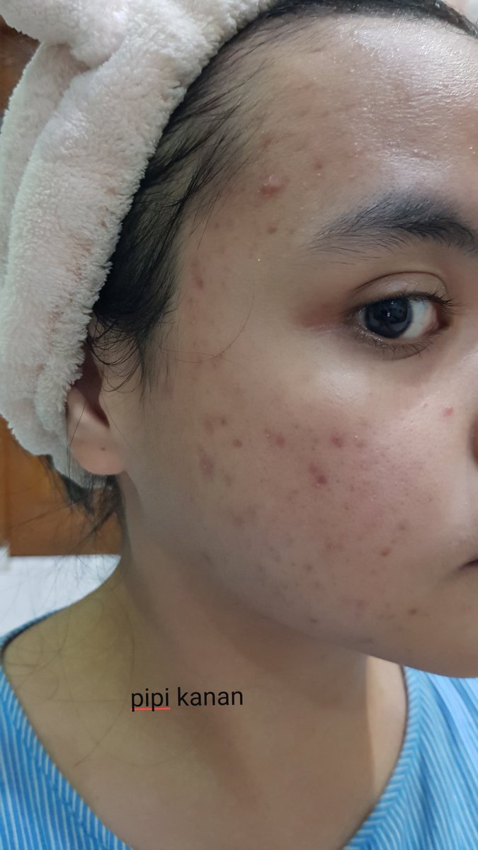 fluffyfunsize_'s tweet photo. My acne journey batch II.
Gonna drop very disturbing pictures of my skin. Need to do this so I can see the progress 🙏🙏

Day 1. https://t.co/qrhBRGFnZd