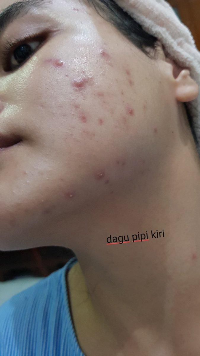 fluffyfunsize_'s tweet photo. My acne journey batch II.
Gonna drop very disturbing pictures of my skin. Need to do this so I can see the progress 🙏🙏

Day 1. https://t.co/qrhBRGFnZd