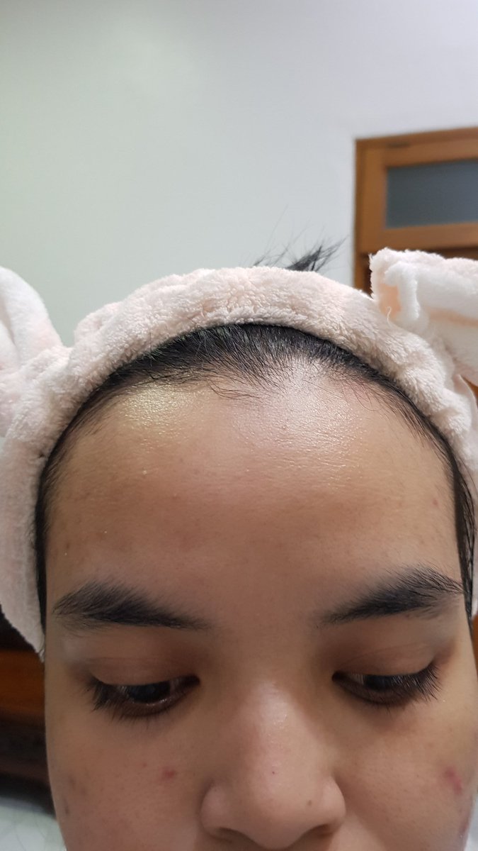 fluffyfunsize_'s tweet photo. My acne journey batch II.
Gonna drop very disturbing pictures of my skin. Need to do this so I can see the progress 🙏🙏

Day 1. https://t.co/qrhBRGFnZd