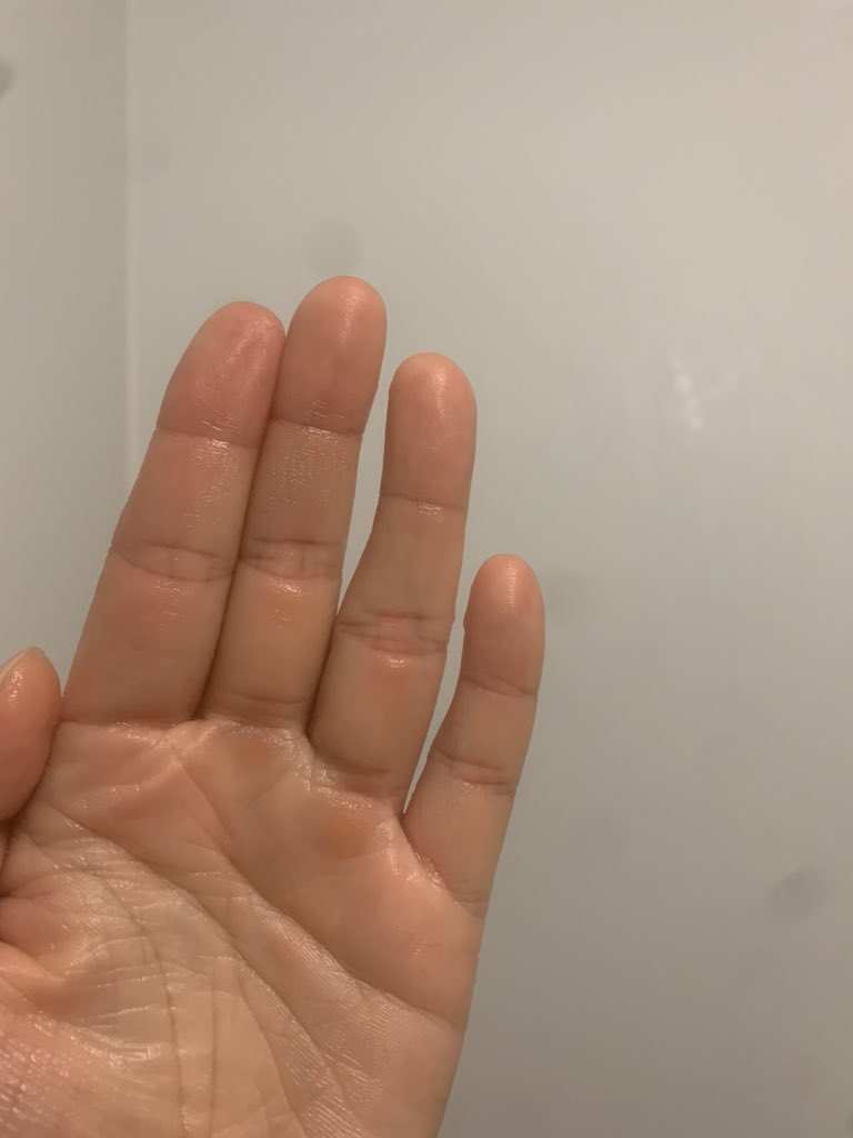 Uzivatel マリ卍 浜松市 Na Twitteru え ってかお風呂で髪洗う時に 何日も前に突き指した薬指 まだ痛いなーと思ったら 曲がってんだけど しかも 左手の薬指 もう結婚できないなこりゃ ってか 曲がってるよね