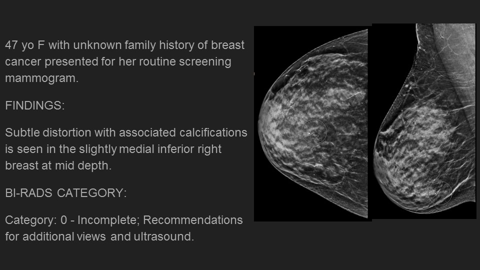 CleMammoEd's tweet photo. Monday case of the day: SCLEROISING ADENOSIS. Big thanks to author @mamaligagalina Dr. Galina Mamaliga @UHRadiology and shout out to our colleagues at @VUMCradiology!  Everyone stay safe! #COVID19  @IUbreastimaging @IURadiology @CariMotuzas @LBSrad https://t.co/Fq2iwwTjdj