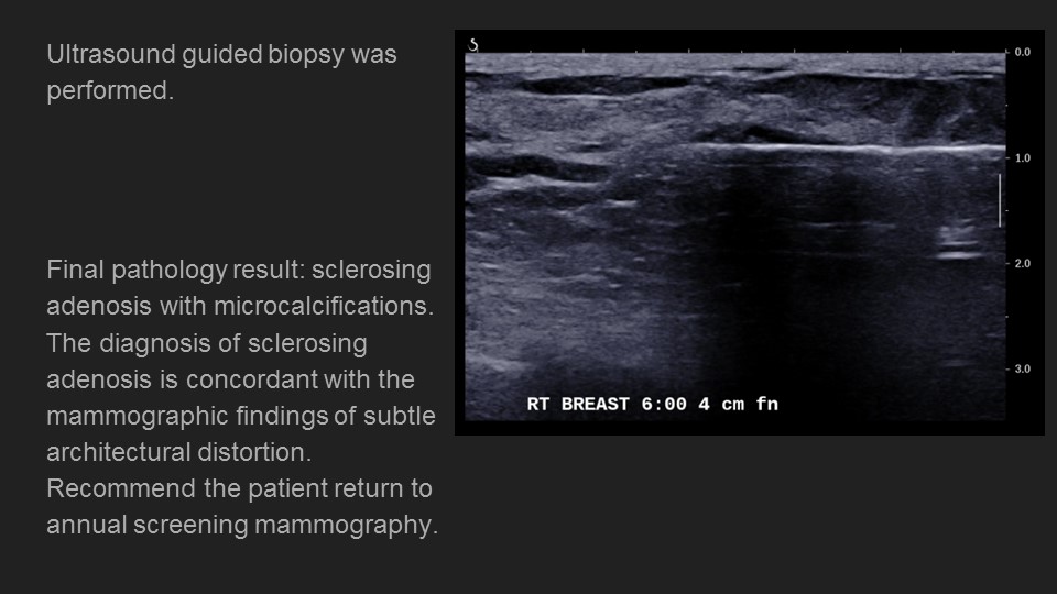 CleMammoEd's tweet photo. Monday case of the day: SCLEROISING ADENOSIS. Big thanks to author @mamaligagalina Dr. Galina Mamaliga @UHRadiology and shout out to our colleagues at @VUMCradiology!  Everyone stay safe! #COVID19  @IUbreastimaging @IURadiology @CariMotuzas @LBSrad https://t.co/Fq2iwwTjdj