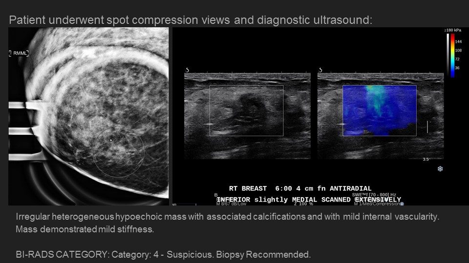 CleMammoEd's tweet photo. Monday case of the day: SCLEROISING ADENOSIS. Big thanks to author @mamaligagalina Dr. Galina Mamaliga @UHRadiology and shout out to our colleagues at @VUMCradiology!  Everyone stay safe! #COVID19  @IUbreastimaging @IURadiology @CariMotuzas @LBSrad https://t.co/Fq2iwwTjdj