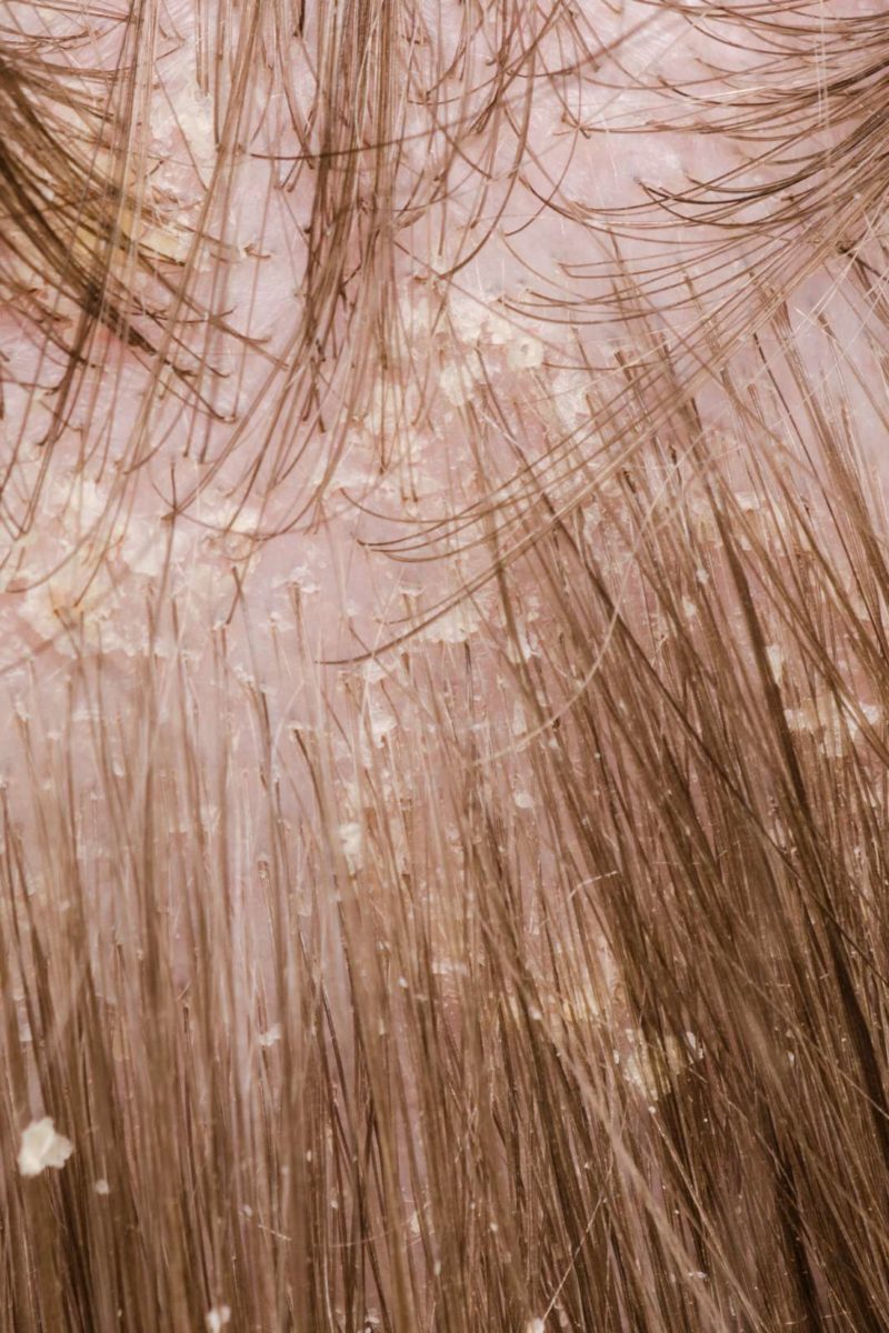 Head Lice In Adults With Color Treated Hair Treated hair, Head louse