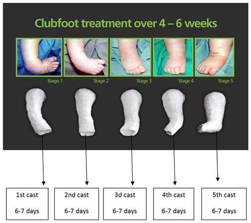 Orthobullets The Ponseti Casting Method For Treatment Of Congenital Clubfoot Corrects Deformity By Addressing Cavus Forefoot Adductus Hindfoot Varus Lastly Equinus C A V E Learn More About Clubfoot Congenital Talipes Equinovarus On