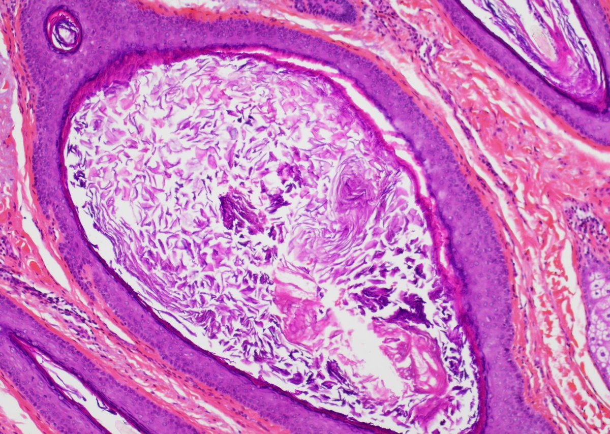 Skin lesion of the cheek in a 70 y-o man 
Clinical hypothesis: skin lymphoma?

#skinpath #pathology #pathologybasics