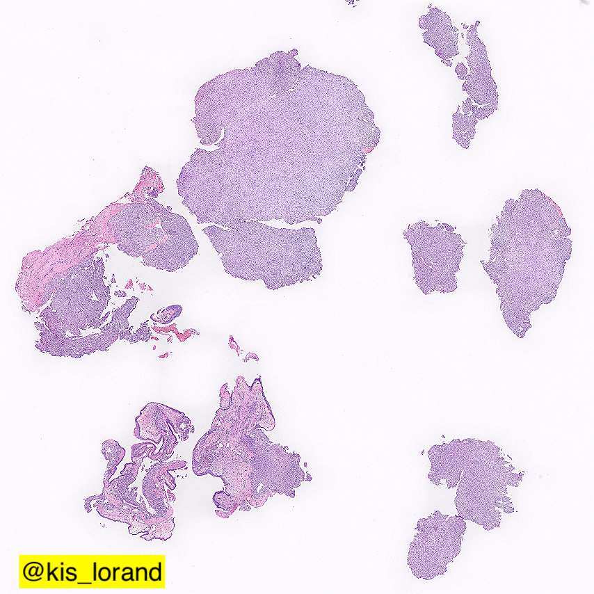 kis_lorand's tweet photo. Nasal polyp with the following histology...
1. What are you Ddx?
2. What are your 5 favored IHC stains?
#pathology #ENTpath #IHCpath https://t.co/QIFFYEywc9