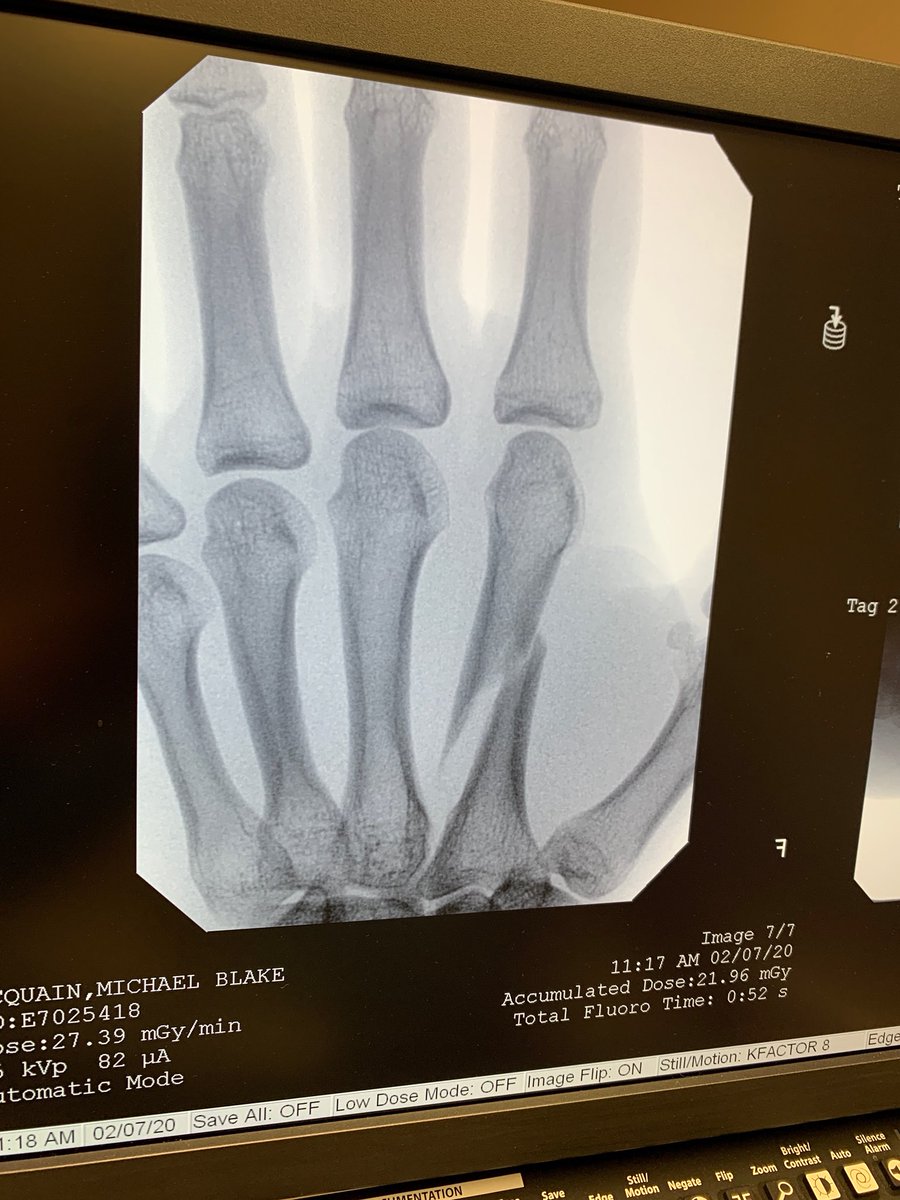 _addifaith_'s tweet photo. 2 months ago I broke my hand. My heart broke since I’d recently gone back to allstar cheer. However, I’ve had a team by my side through it all &amp; they have encouraged me every step of the way. They keep me motivated during this time. Y’all are my MOTIVATION MONDAY @twistandshout1 https://t.co/DVO82kGpr1