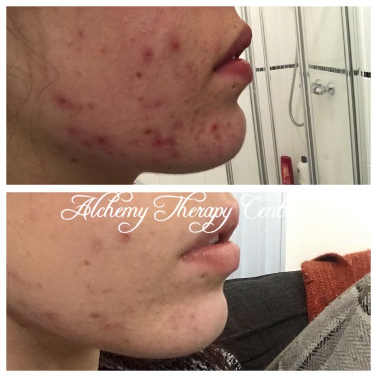 AlchemyTherapy's tweet photo. 3 #benefits of #Environ #facials 
 
1. High levels of #vitamin A,C and E to help with any #skin concerns.  
2. Soundwaves and electrical current help to push #products to the bottom layer of the skin. 
3. Measurable differences after just one session. 
photo taken 7 days apart https://t.co/asW9dp7gZz