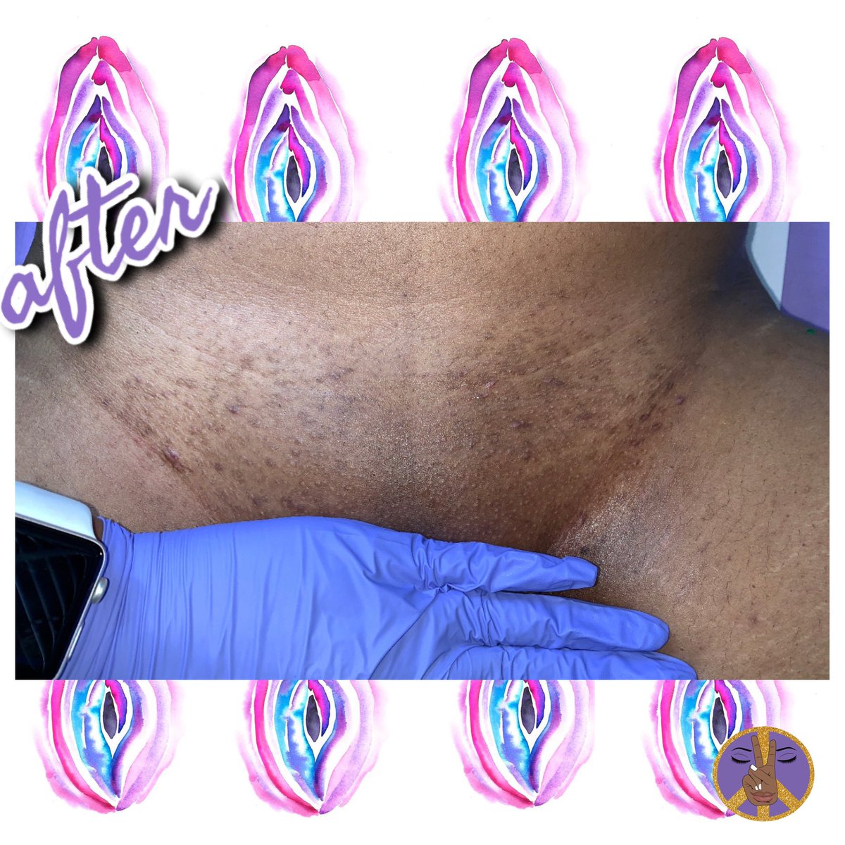_peaceofcolor's tweet photo. 🚨#skinPEACE☮️✨:
this is a pocture of a woman’s private area, keep scrolling if you’re uncomfortable!
———
Brazilian Wax a few weeks ago
NOW OFFERING THIS SERVICE.
——
#PEACEofCOLOR☮️✨ https://t.co/jT2J0tY75P