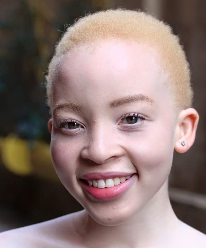 Sheddi_younG's tweet photo. There's beauty in albinism: u don't have to be ashamed of yourself or of your relative cause of it

Here's what you need to know/do:
1) limit your exposure to sunlight
2) wear appropriate hat and clothin
3) Use your sun screen diligently
4) sunscreens containing SPF
Yanny Laurel https://t.co/hTwz3n85DX