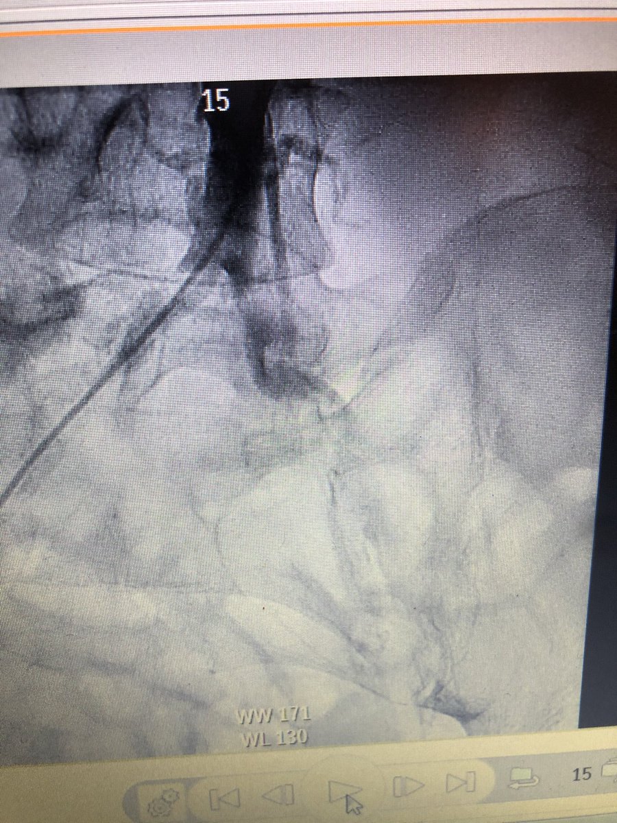 rzakir12's tweet photo. Cases nearly at standstill due to covid 19.. but today did a single access impella facilitated with shockwave in pt with nstemi, refractory CHF, LVEF 20% with severe calcified multiveseel disease with poor hemodynamics @MacAnsari @DrAmirKaki @ProtectedPCI @matheenkhuddus https://t.co/2TaVoE5Zr3