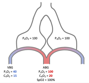 To understand why HPV is important, imagine a simple two alveoli model of the lung. Normally oxygen content (CaO2) and saturation (SpO2) increase as blood crosses the alveolar capillaries. This brings the oxygen level from venous SpO2 of 70% up to an arterial SpO2 of 100%.3/