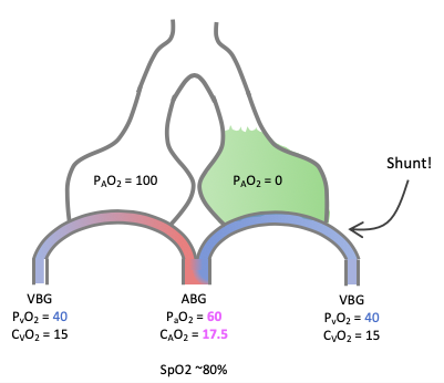 What happens if one alveolus is filled with fluid? Deoxygenated blood would go through the pulmonary vasculature without picking up any oxygen. This is Shunt.4/