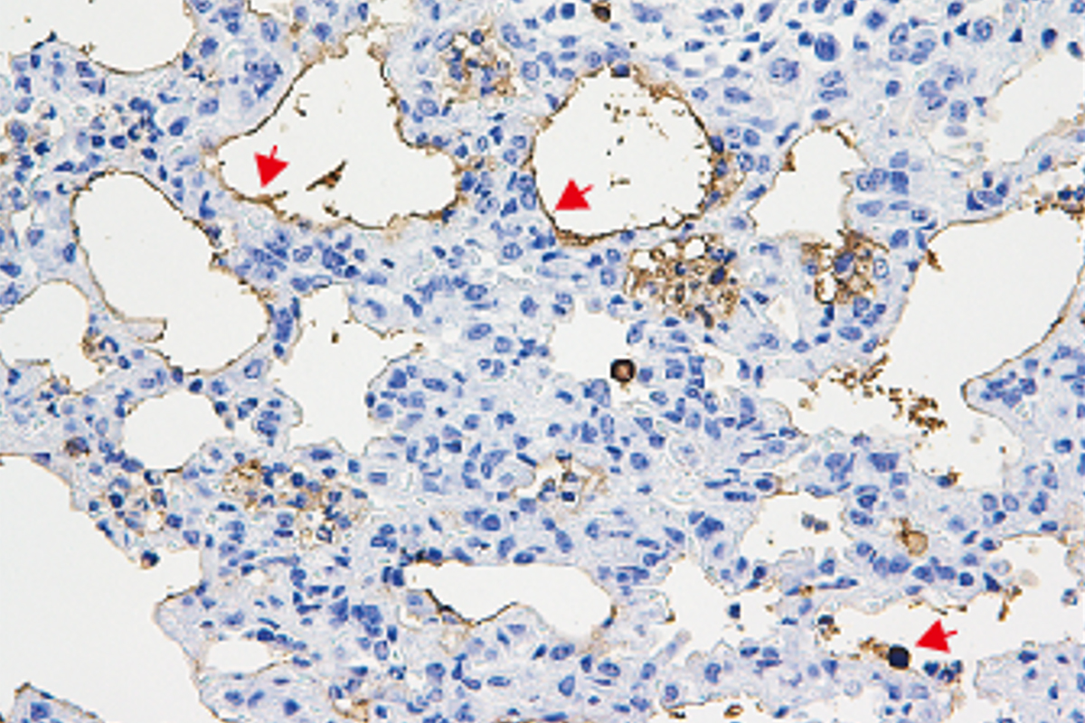 pulmonary_news's tweet photo. Bacterial protein fragment kills #LungCells in #PulmonaryFibrosis, study from @NewsAtIllinois finds. https://t.co/LRr8x1l8jP https://t.co/iD7HBRmgz8