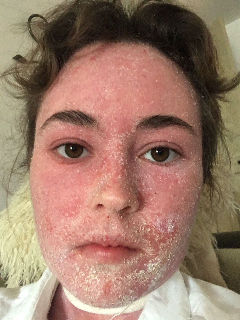 Cassandra Bankson Eczema Is Commonly Misunderstood From Mild To Very Painful It Can Show Up As Dry Itchy Scaly Skin It Is Hereditary Can Run In The Family And Otc