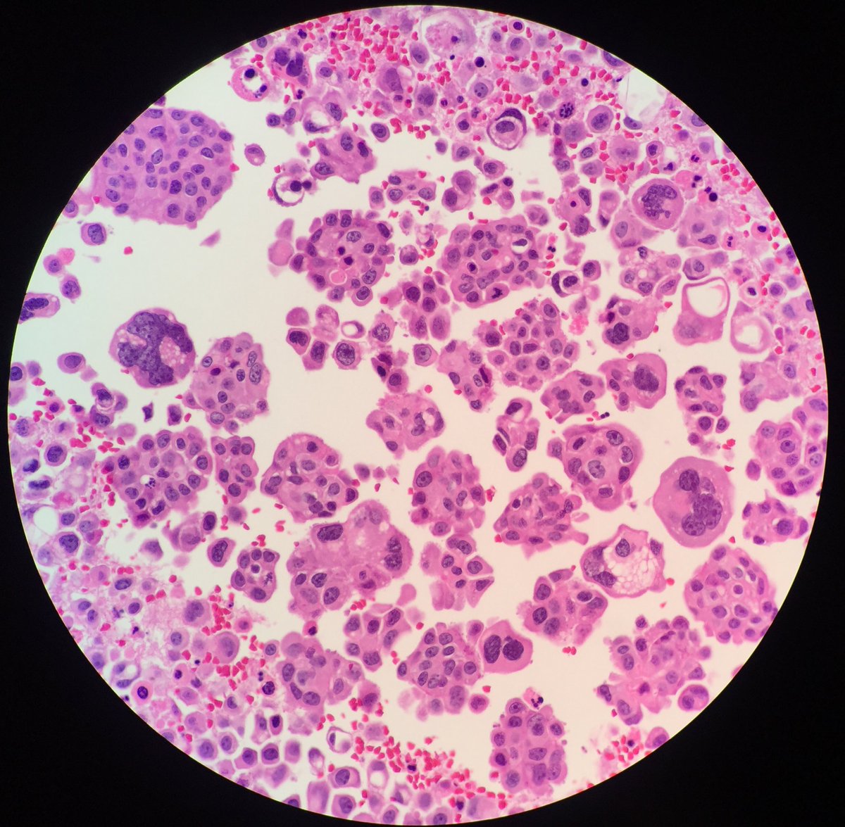 TCytologist's tweet photo. It’s been a while.😊
Case on working today.Male 72yrs. Plural fluid,pap stain and cell block technique H&amp;E stained.
💉💉 🔬🔬🦠🦠 #cytology  #papstain #cytopatho #cytopath  #cytotechnologist #cytologists https://t.co/NS2L1qWRoY