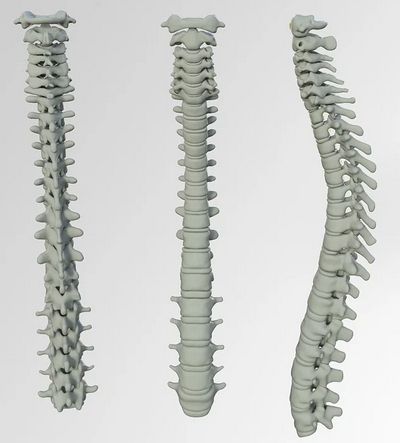 apex_spine's tweet image. Grundsätzlich gibt es unterschiedliche Arten von Deformitäten der Wirbelsäule. Die Kyphose bei älteren Menschen ist die wohl bekannteste und häufigste Deformität der Wirbelsäule.

buff.ly/2WKqNFr