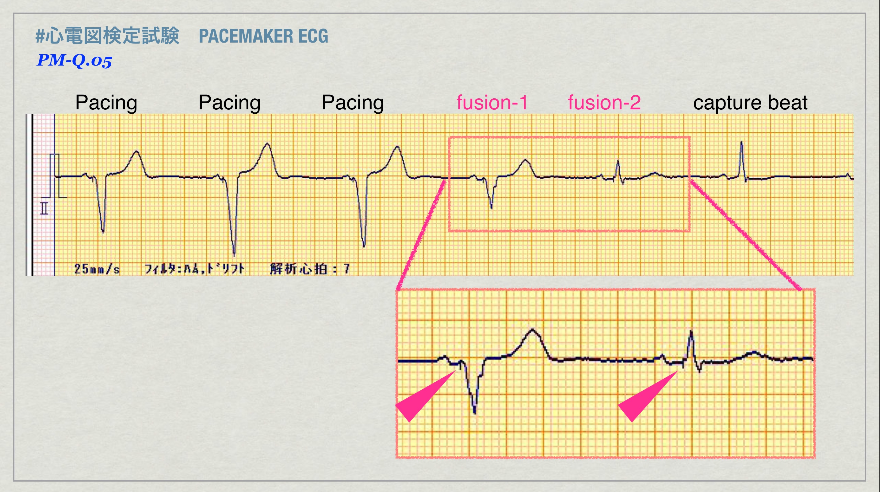 N Tsukishima Ep大学心電図検定学部試験対策科担任 心電図検定試験 Pm Ecg 49 Q 5 Answer 3 今度は P波も心室にちょっと進入しました Vvi Pacing波形と心室内で混ざり合っています Fusion Beatです 電気軸は上方軸ですが ちょっと電位が減っています