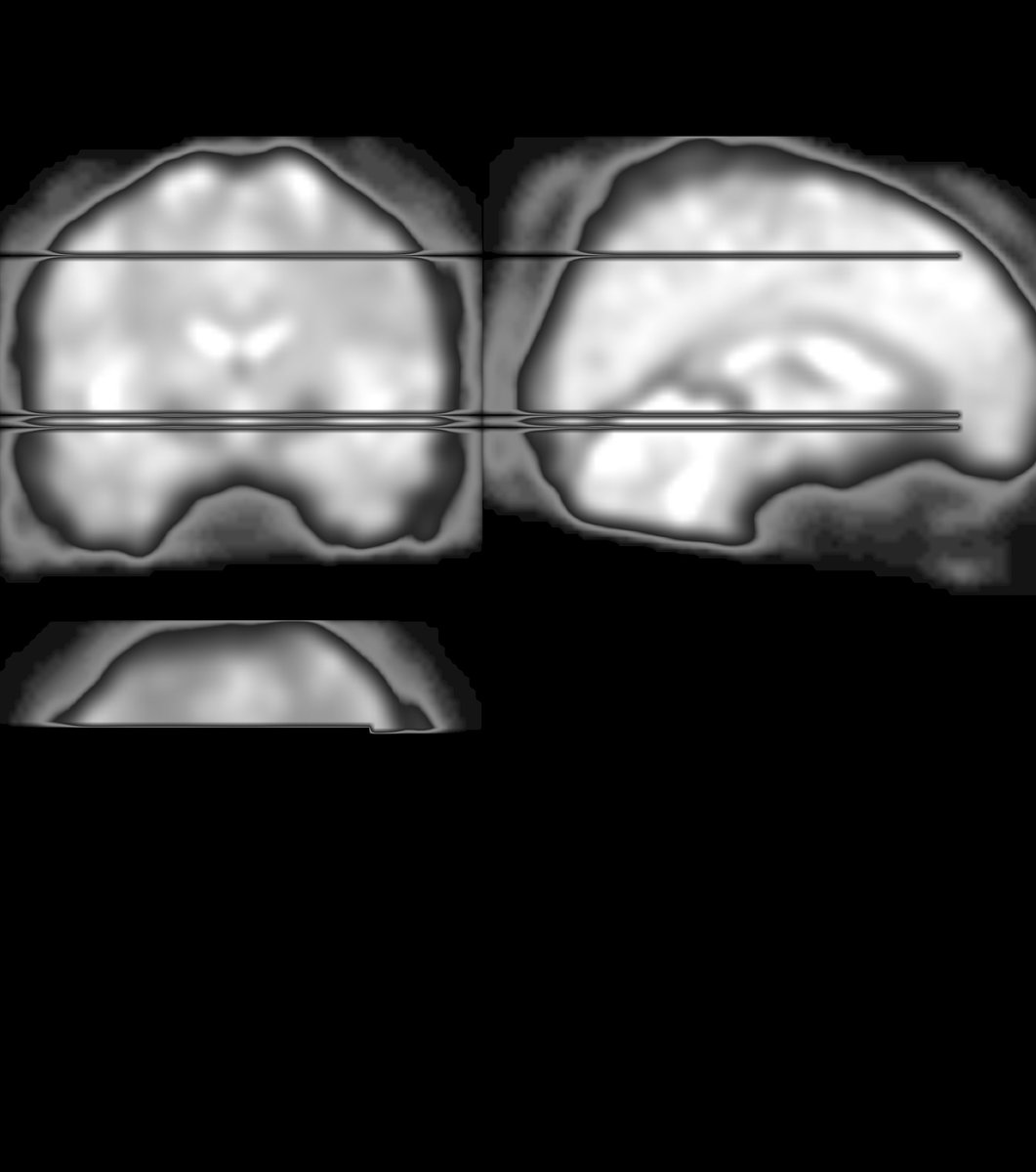 DPfabigan's tweet photo. Hei #fmri folks! Any idea what went wrong here while smoothing in #spm12? It's independent of smoothing kernel, slice time correction y/no, or scanner artefacts... 🤔 https://t.co/srq9QSqGMl