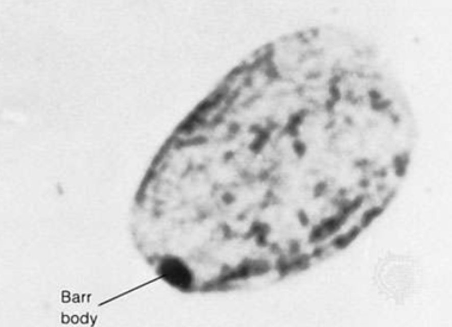 drM_sudha's tweet photo. 4/ Why is that!? I have one word for you #lyonization aka random inactivation of one of the X chromosomes (the infamous #Barrbody). How sad☹ https://t.co/4iibNC8Nhy