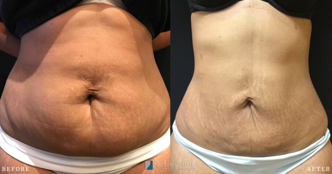 reflectionsctr's tweet photo. Our patient is feeling healthier thanks to Dr. Wix-Harris and Vaser SmartLipo!

#ReflectionsCenter #VaserSmartLipo #SmartLipo https://t.co/GBtmqnEQnC
