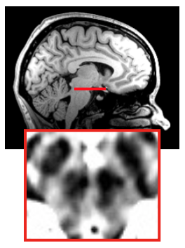 We specifically measured brain activity in the substantia nigra, a midbrain dopaminergic region that is involved in craving food, when hungry, or drugs, when addicted. 5/25