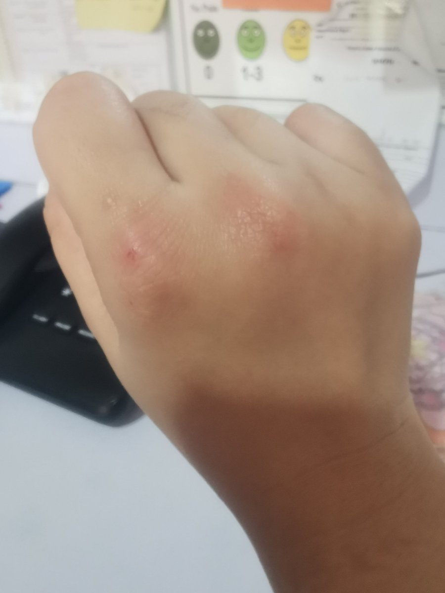 pray4csy's tweet photo. Been wearing surgical gloves for 12 hours everyday for 3 days and my hands are starting to have blisters and allergic reaction. https://t.co/8DRWPSmara