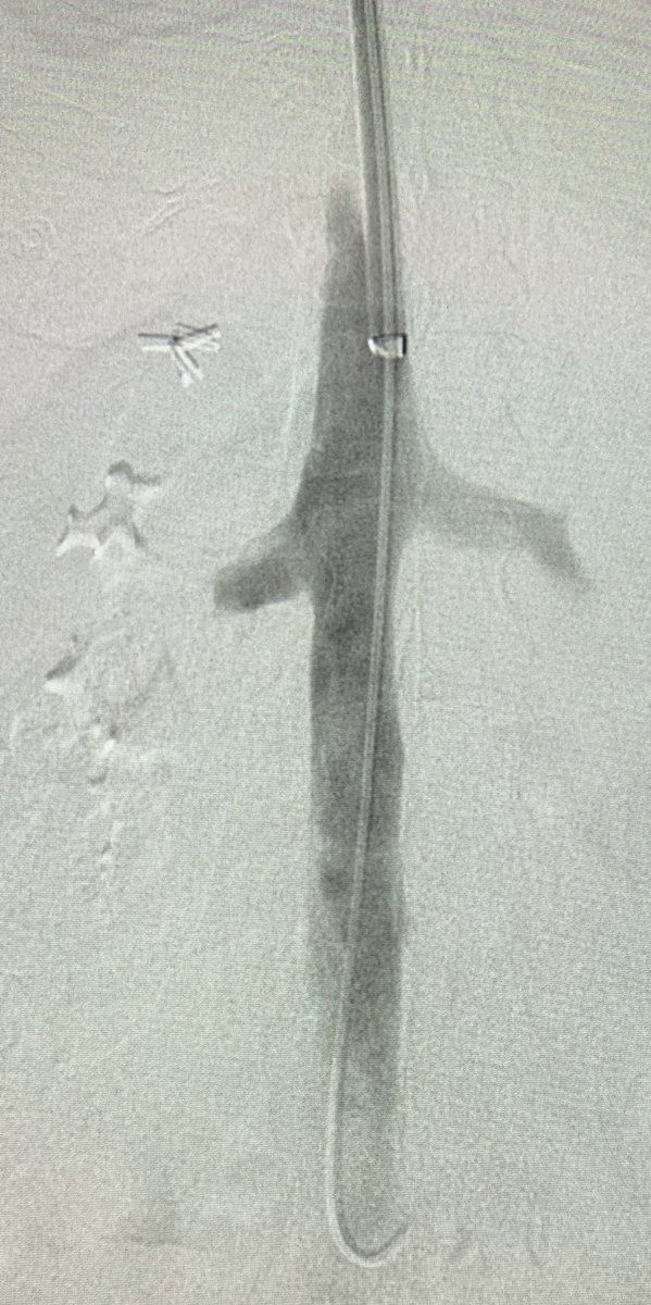 t_intheleadcoat's tweet photo. PreCOVID. #IVCfilter dwell time approx 9 years. Hook embedded. Legs penetrated. Filter retrieved by “folding” after wire looped and snared between the IVC wall and hook. #filterretrieval demands techniques tailored to filter type and anatomy. #irad @SIRspecialists @SIR_ECS https://t.co/z63cIk0H98