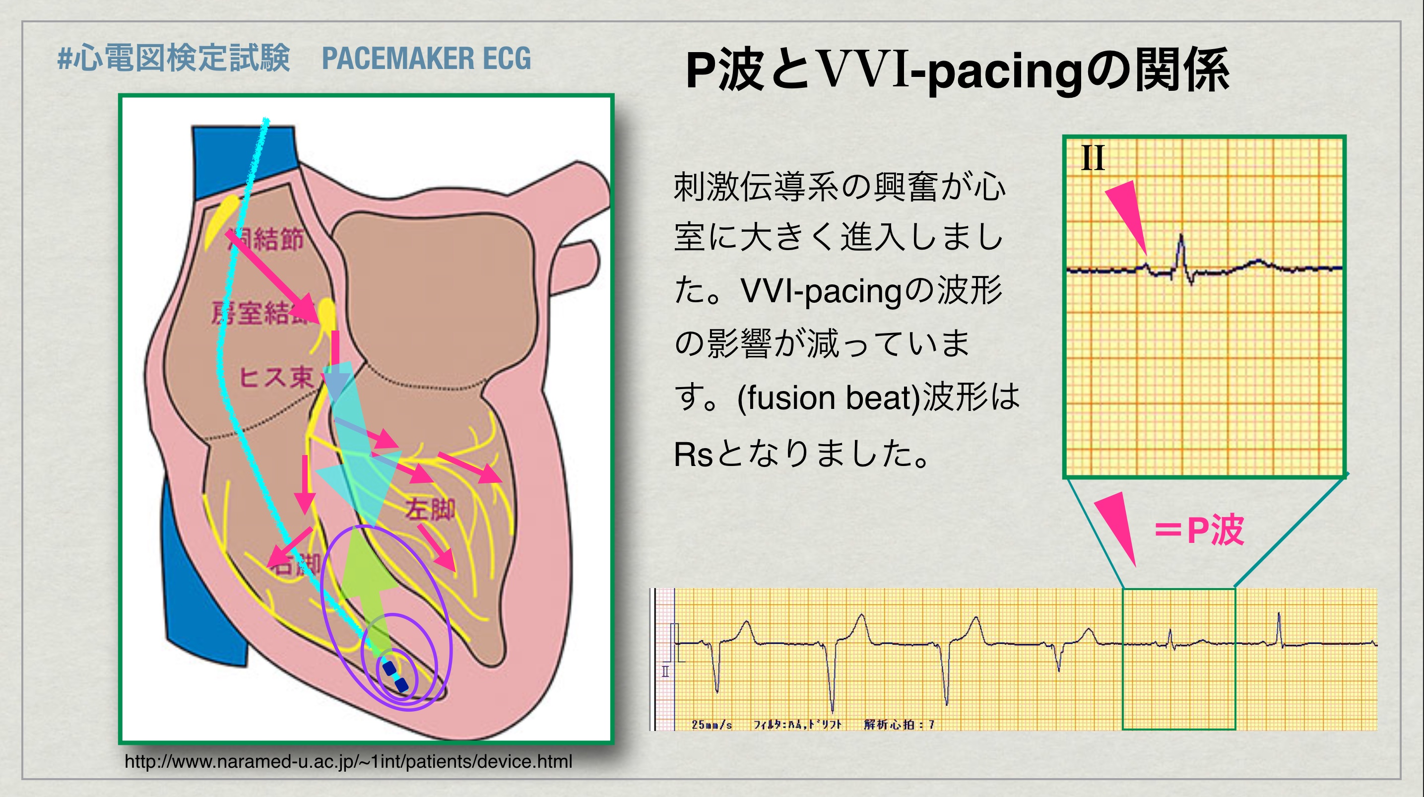 N Tsukishima Ep大学心電図検定学部試験対策科担任 心電図検定試験 Pm Ecg 49 Q 5 Answer 3 今度は P波も心室にちょっと進入しました Vvi Pacing波形と心室内で混ざり合っています Fusion Beatです 電気軸は上方軸ですが ちょっと電位が減っています
