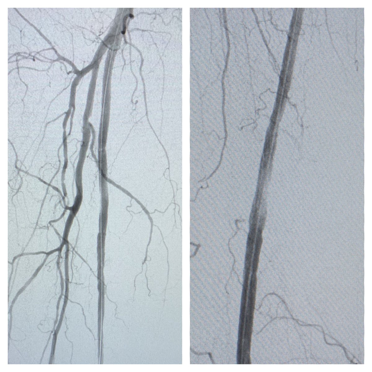 SaadJraib's tweet photo. At #corona times:
90 yrs old M with CLI. Flush #CTO of #SFA with no “stump”, recanalized in antegrade #subintimal fashion + #angioplasty+ #stenting
@sirs_ksa @MoonJustaniah @AshourMD https://t.co/vITTqw3a3r