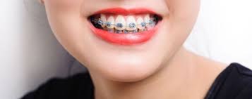 damonsmile_in's tweet photo. Damon System, Braces. Different types of braces. Reviews, Cost and Procedure. #damonbraces #damonsmile #braces #bracesoff #braceslife #bracesproblems #bracesfree #bracesjourney #bracesgirl #BracesFace #bracesstruggle #bracestransformation #bracesmetal #braceson #bracesarecool https://t.co/oV2x58xMAy