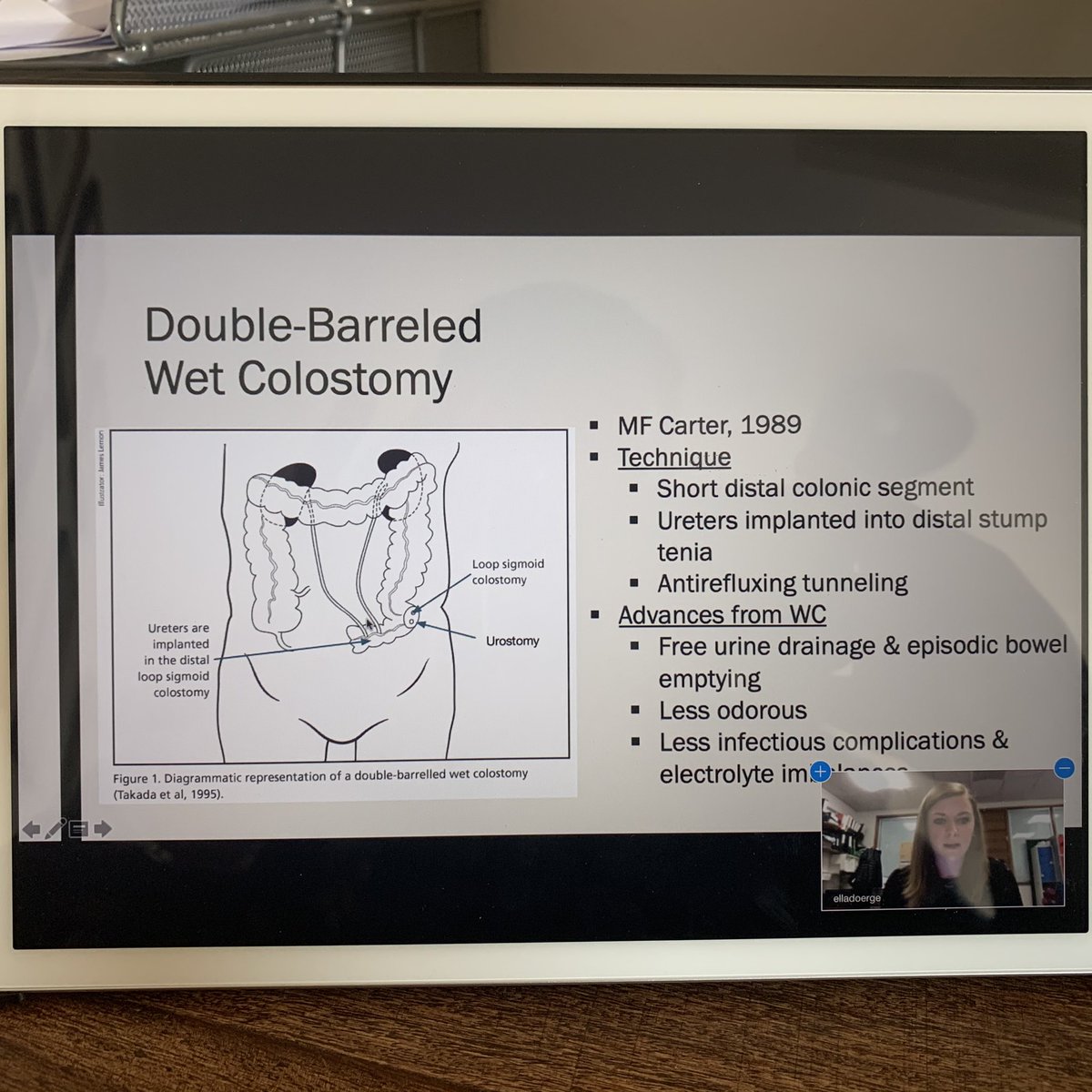Ben Challacombe (@benchallacombe) on Twitter photo <a href="/GuysUrology/">Guy's Urology News</a> does first @zoom_us Friday morning teaching. #COVID2019 in transplant pt. the wet colostomy for large pelvic mass to avoid bowel anastomosis. #COVID2019 update <a href="/GSTTnhs/">Guy's and St Thomas'</a> <a href="/tsoburol/">Tim O'Brien</a> <a href="/MattBultitude/">Matthew Bultitude</a> <a href="/sonnyurol/">Arun Sahai</a> <a href="/nairajesh/">Rajesh Nair</a> <a href="/CityUrology/">Jonny Olsburgh</a> brilliant and safe! <a href="/GuysUrology/">Guy's Urology News</a> does first @zoom_us Friday morning teaching. #COVID2019 in transplant pt. the wet colostomy for large pelvic mass to avoid bowel anastomosis. #COVID2019 update <a href="/GSTTnhs/">Guy's and St Thomas'</a> <a href="/tsoburol/">Tim O'Brien</a> <a href="/MattBultitude/">Matthew Bultitude</a> <a href="/sonnyurol/">Arun Sahai</a> <a href="/nairajesh/">Rajesh Nair</a> <a href="/CityUrology/">Jonny Olsburgh</a> brilliant and safe!