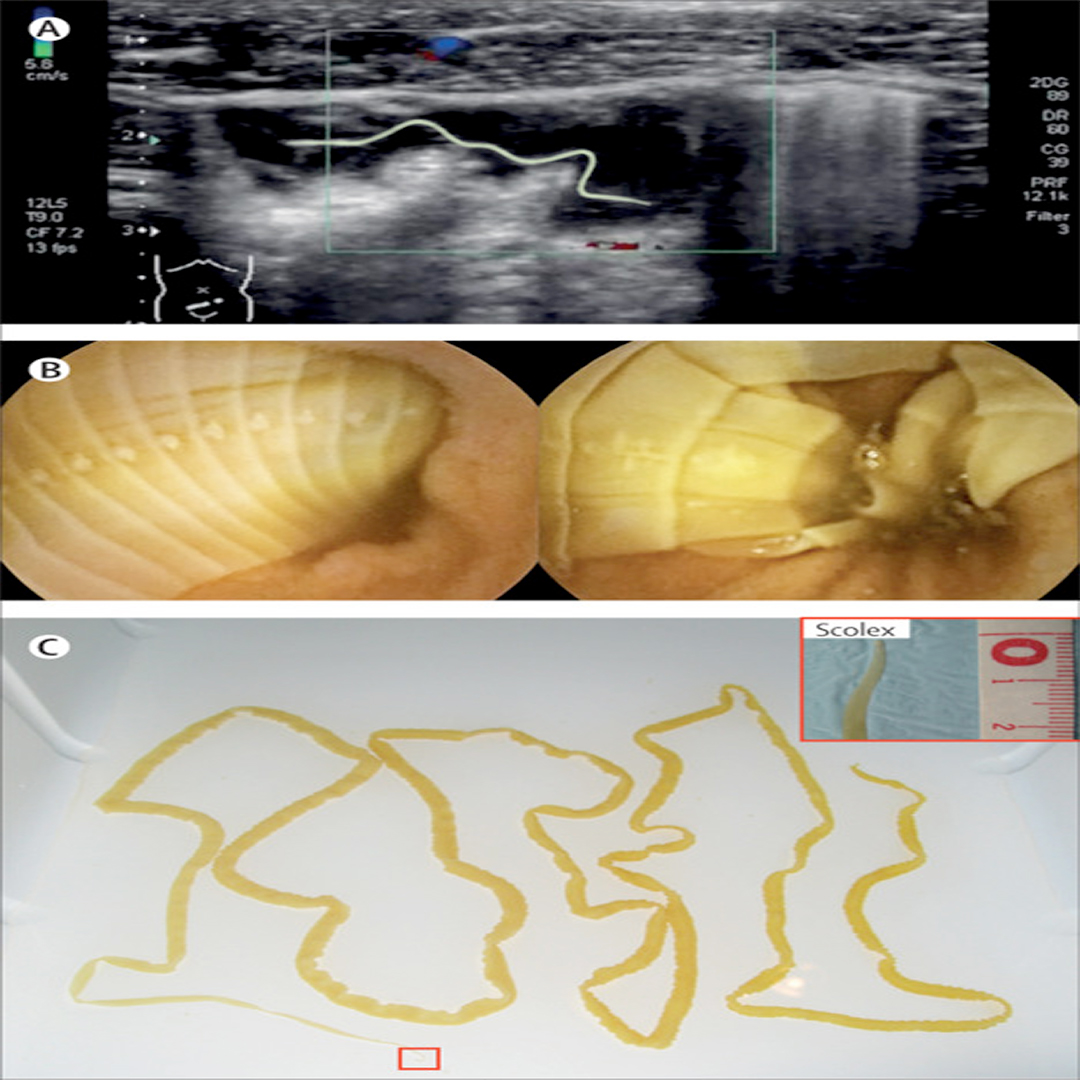 UTHSCPAprogram's tweet image. Answer:  210cm Intestinal diphyllobothriasis

thelancet.com/journals/lance…