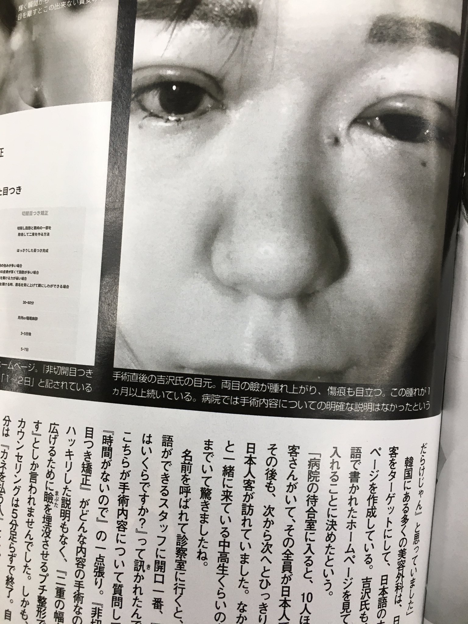 紅魅 ｸﾐ 今日発売のfridayに 韓国の美容外科で整形失敗されたグラドルの告発記事が載ってた 怖いね 非切開 目つき矯正 T Co Iaenrz3t7m Twitter