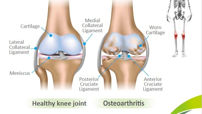 uocuk2's tweet photo. #Osteoarthritis is a chronic disease caused by breakdown of cartilage or natural cushion at the end of bones. It occurs most often in knees, hips &amp; hands. Over time, it can damage ligaments, menisci &amp; muscles, &amp; may create the need for a knee replacement or arthroplasty. #MedEd https://t.co/PfD2MD39b6
