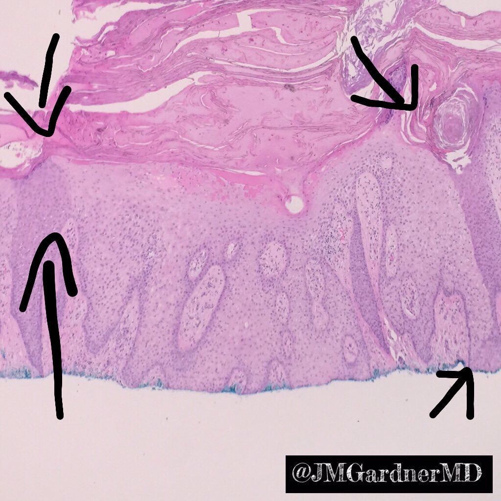 JMGardnerMD's tweet photo. Clear (pale) cell acanthoma. Benign solitary skin lesion. Clue: Sharp demarcation from normal epidermis. more info in my #dermpath #pathsurvivalguide book: https://t.co/85dyJi37nn #Pathology #dermatology https://t.co/44HaD7sFGv