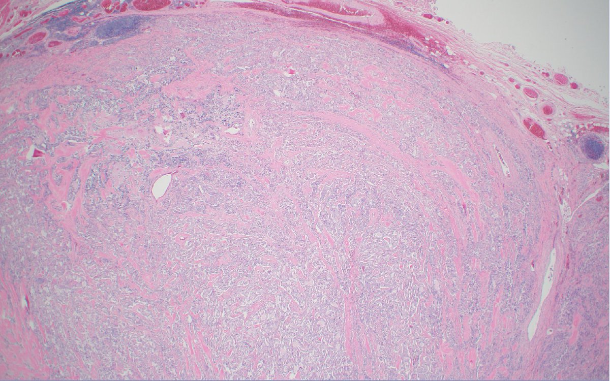 mhassanaimc's tweet photo. 55/M with thyroid with Medullary thyroid carcinoma #headnneck path https://t.co/2yp7ddJBS9