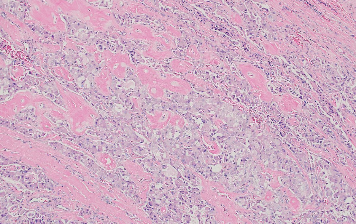 mhassanaimc's tweet photo. 55/M with thyroid with Medullary thyroid carcinoma #headnneck path https://t.co/2yp7ddJBS9