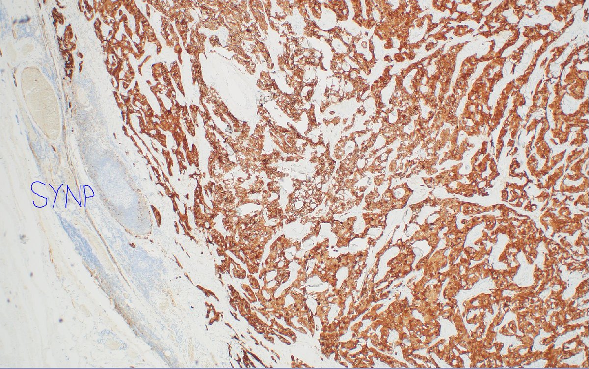 mhassanaimc's tweet photo. 55/M with thyroid with Medullary thyroid carcinoma #headnneck path https://t.co/2yp7ddJBS9