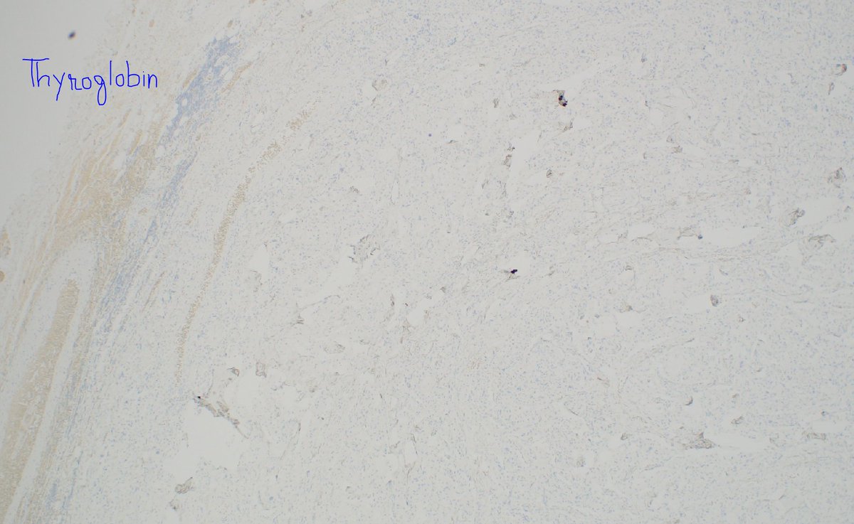 mhassanaimc's tweet photo. 55/M with thyroid with Medullary thyroid carcinoma #headnneck path https://t.co/2yp7ddJBS9