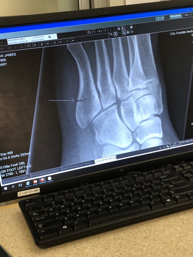 PunchBaggy's tweet photo. I’m not SICK! Just decided to fall off a ladder and break the fall with my foot. 2 breaks! One in my foot and other in my ankle! Not how I wanted to spend last Saturday afternoon or while being quarantined! Stay healthy everyone! #Calgary #Quarantine #BrokenFoot #Covid19 #TGIF https://t.co/mby8eLFRDT
