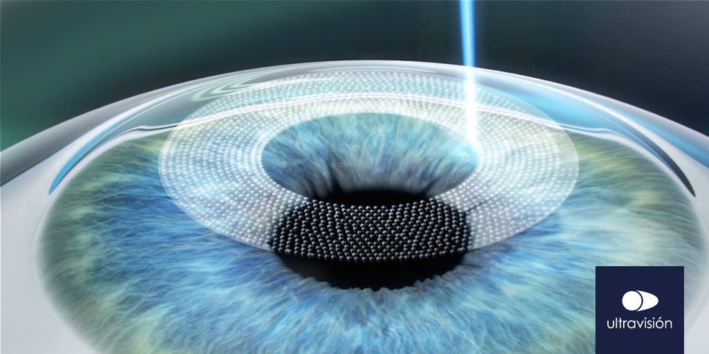 ultravisioncl's tweet photo. En solo minutos, olvídate de los lentes. Agenda tu evaluación sin costo para Cirugía Lasik: https://t.co/vArb7JdLmF https://t.co/HYo01aFMLx