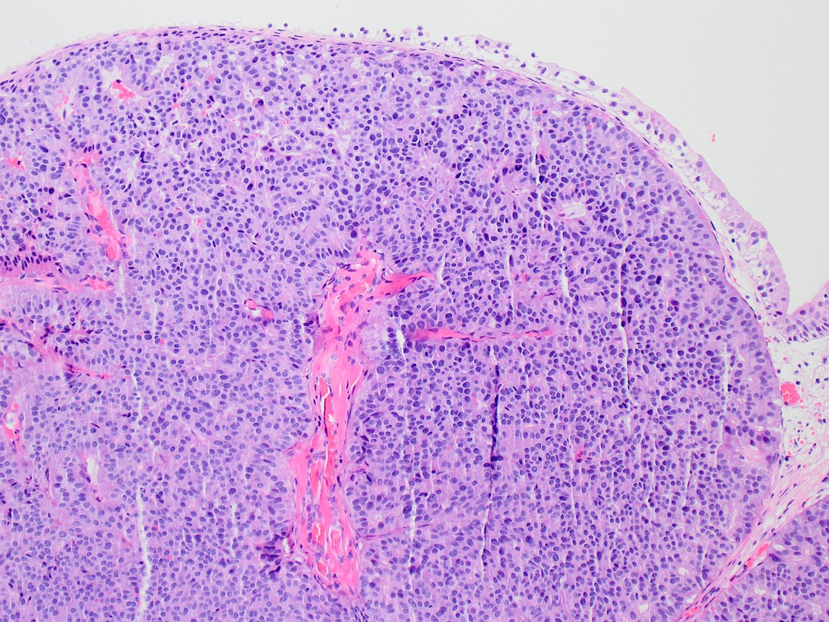 Kiril_T_Can's tweet image. 60 y/o female, bladder mass 🔬🤔 #GUpath #bladdercancer #pathology
