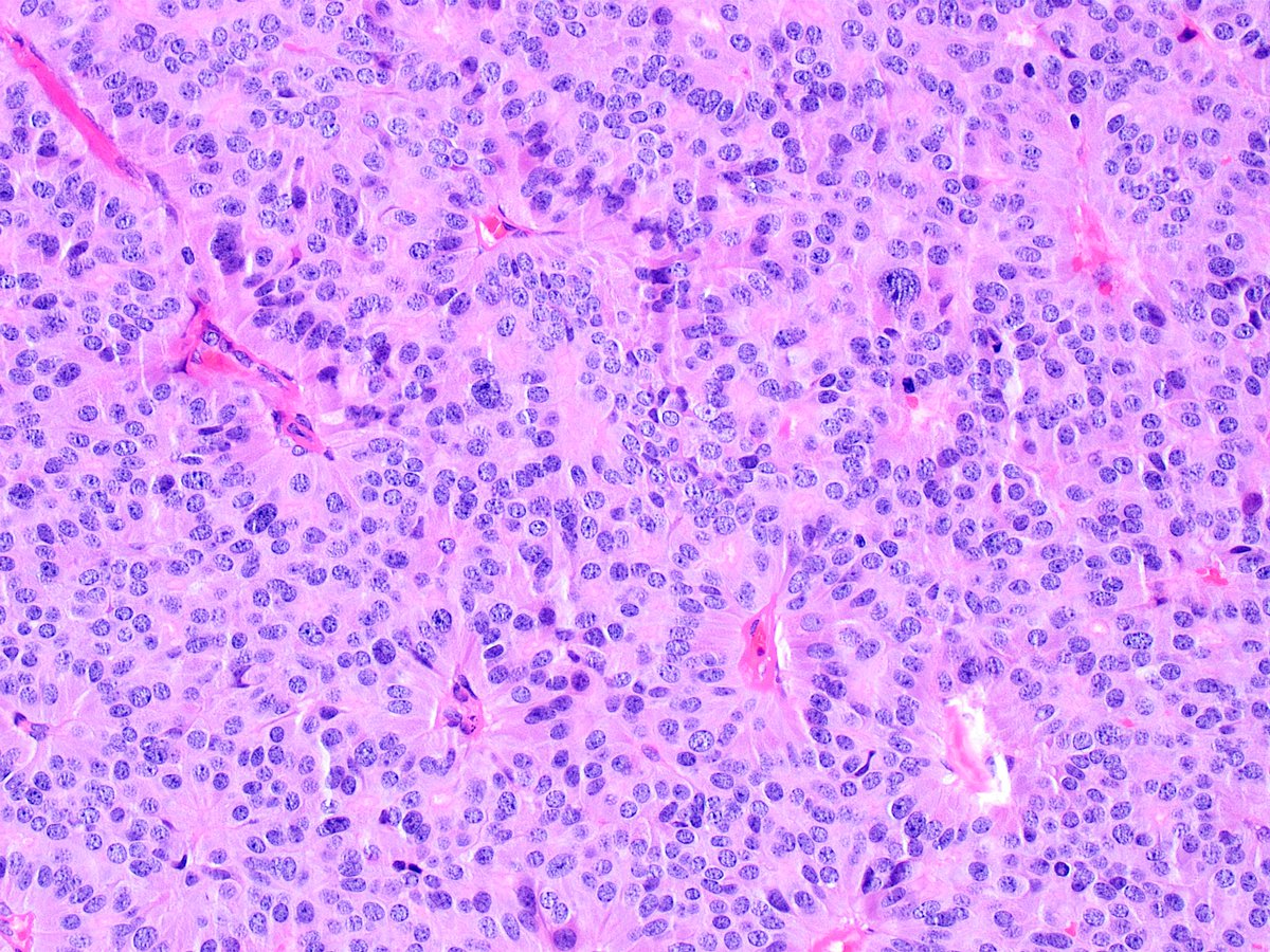 Kiril_T_Can's tweet image. 60 y/o female, bladder mass 🔬🤔 #GUpath #bladdercancer #pathology