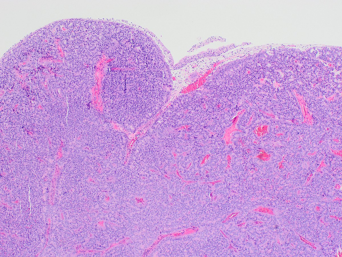 Kiril_T_Can's tweet image. 60 y/o female, bladder mass 🔬🤔 #GUpath #bladdercancer #pathology