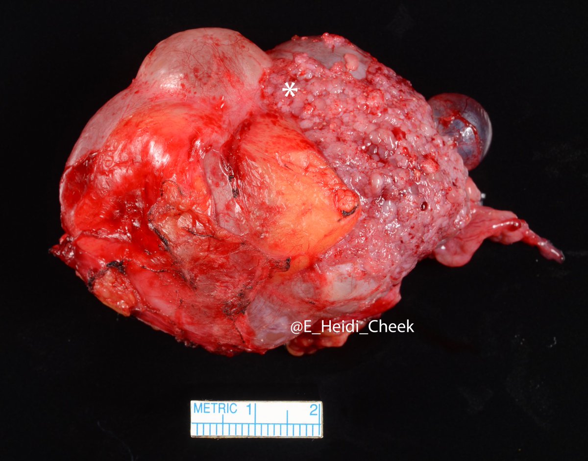 E. Heidi Cheek, MHS, PA(ASCP) tweet media