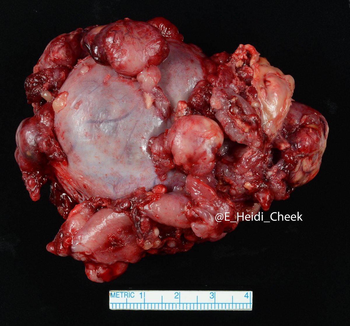 E. Heidi Cheek, MHS, PA(ASCP) tweet media