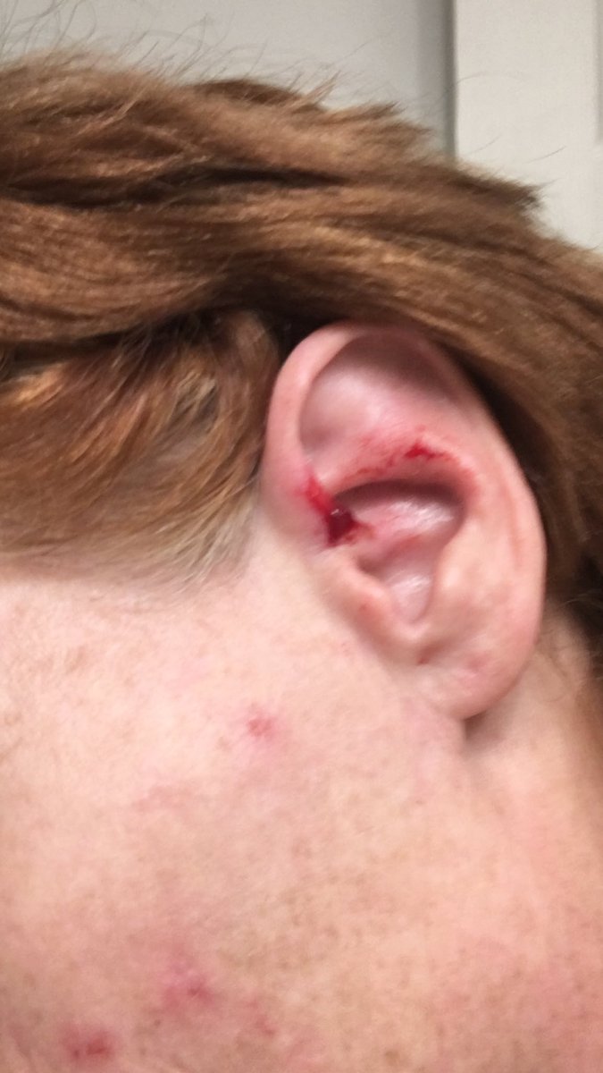 TamRealtor's tweet photo. @USNavy US Navy help me plz as AI is hitting me with some type of radiation in my neck ears skin at my home in Indiana here are pics Tammy Bryan https://t.co/70wtKSUcLl